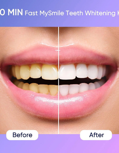 Load image into Gallery viewer, Ultimate Teeth Whitening Kit with 28 LED Light, 4X 3ML 35%CP Teeth Whitening Gel, 1X 4ML Teeth Whitening Pen, 10 Min, Remove 10 Years of Stains
